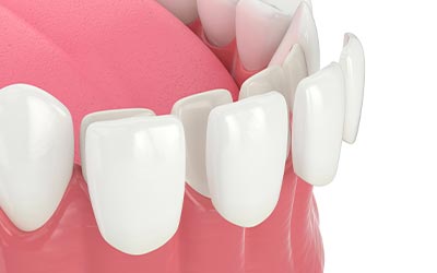 dental veneers diagram