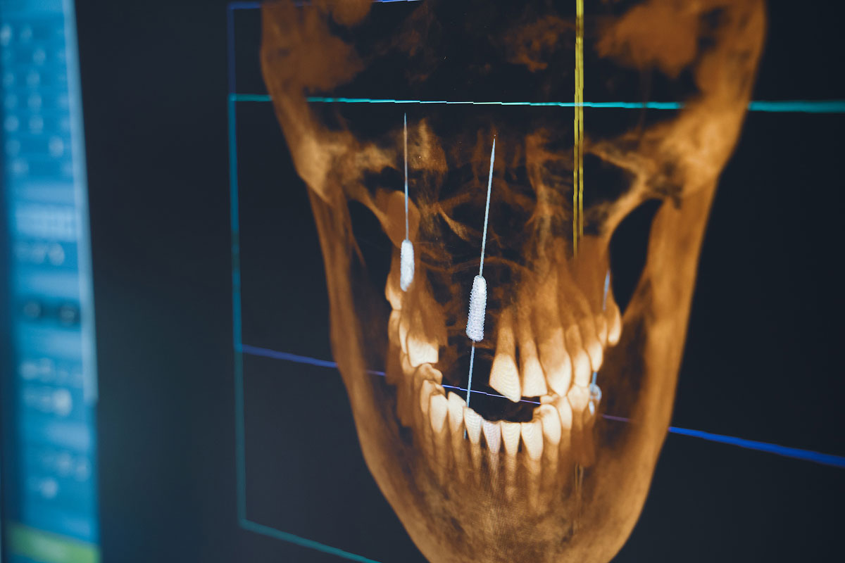 Dental implants at Stono Dental Care