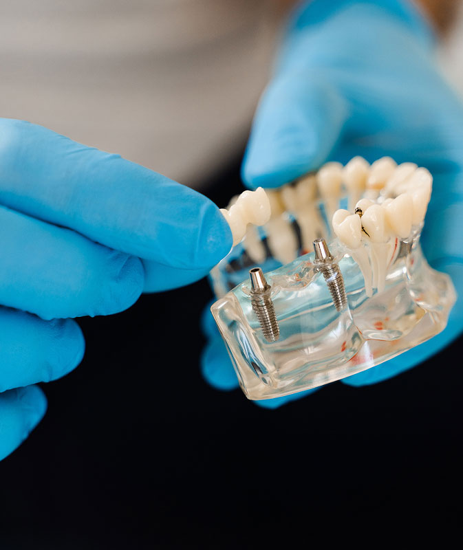 Dental implant model at Stono Dental Care