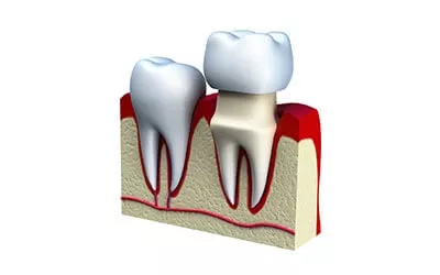 dental crown diagram