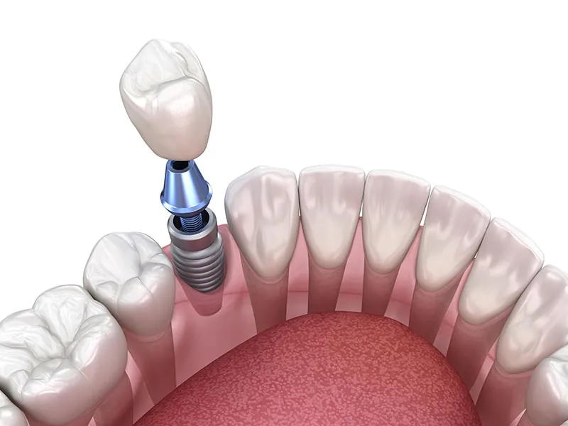 Dental implant with abutment and crown, 3D render